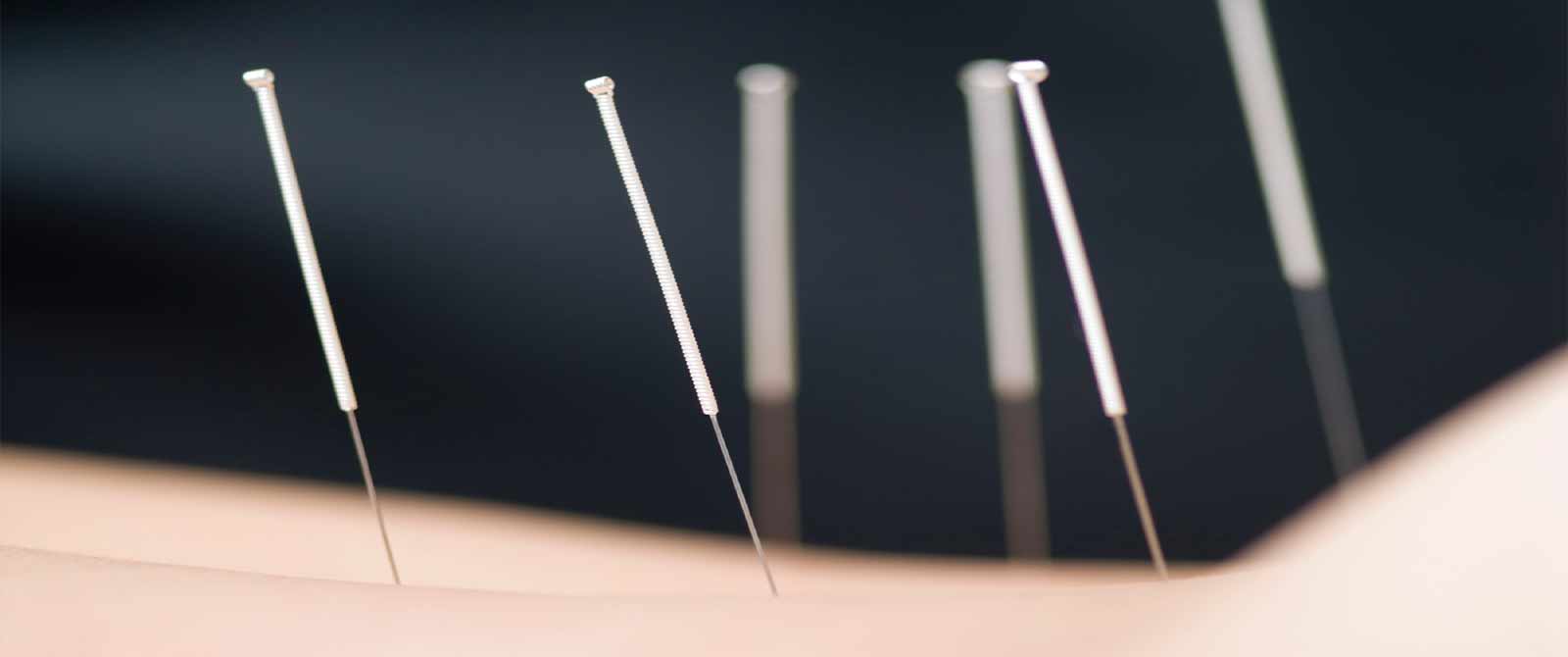 acupunctuurpraktijk haarlem