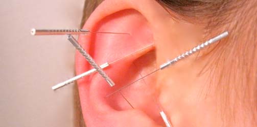 Ooracupunctuur Acupunctuur oor drukpunten