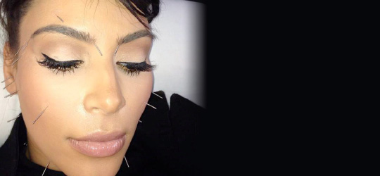 Kim Kardashian Acupunctuur