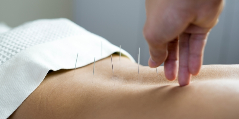 Chinese acupunctuur