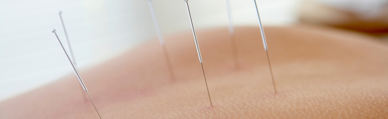 Acupunctuur bij stress en mentale klachten