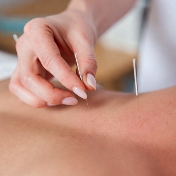 Chinese Acupunctuur Haarlem